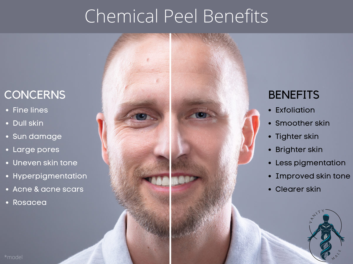 Chemical Peels Benefits