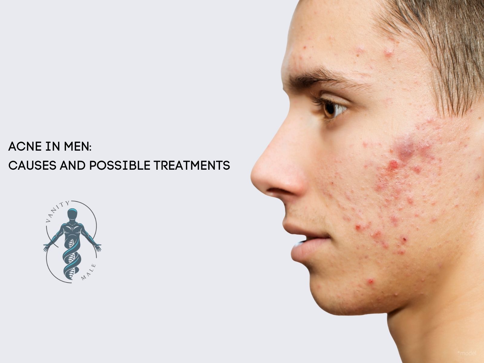 Acne in Men; Causes and Possible Treatments