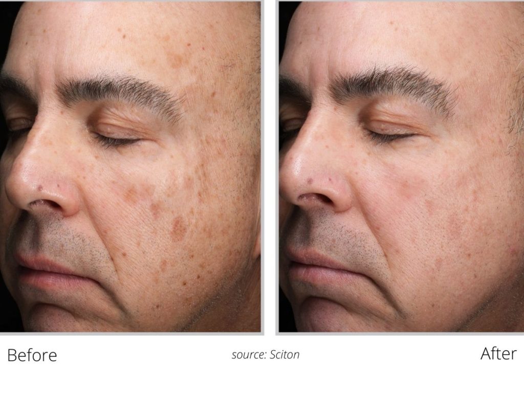 Laser Skin Resurfacing for Age Spots and Sun Damage